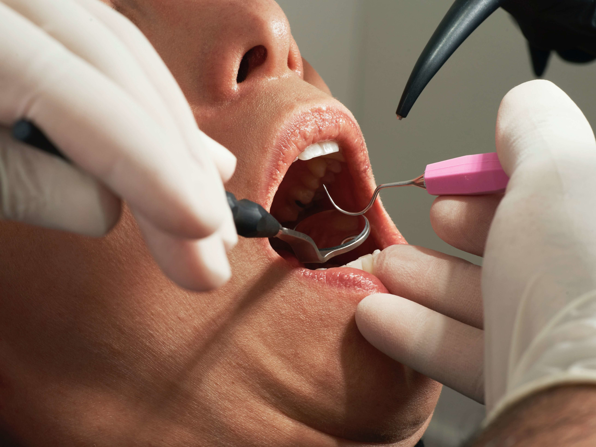 Stan zapalny miazgi zęba – czym się objawia i jak go leczyć?