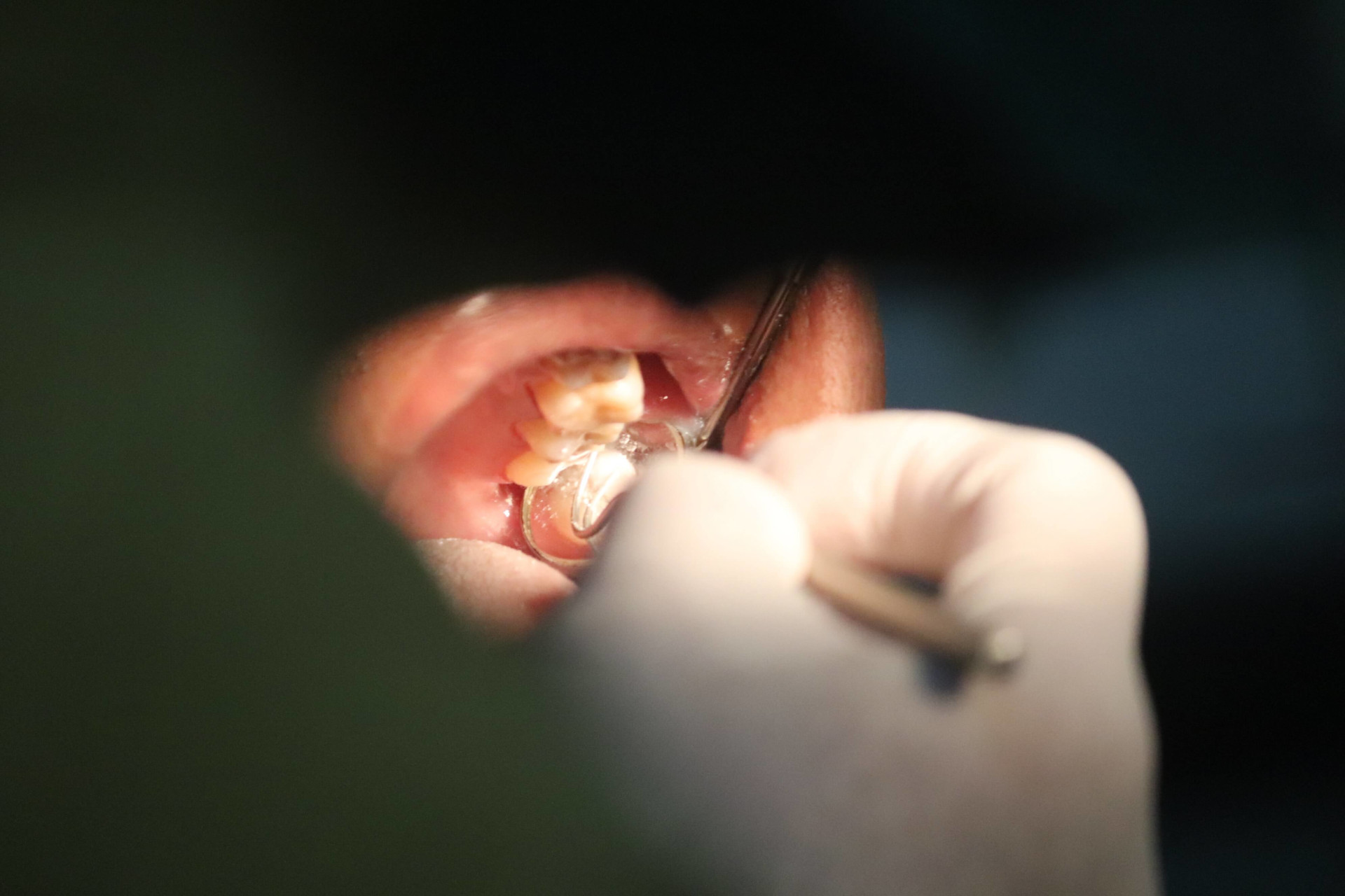 Próchnica zębów u dzieci i dorosłych – jak wygląda, powody występowania oraz leczenie