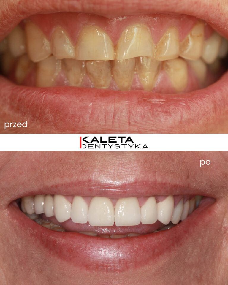 Korony i implantokorony