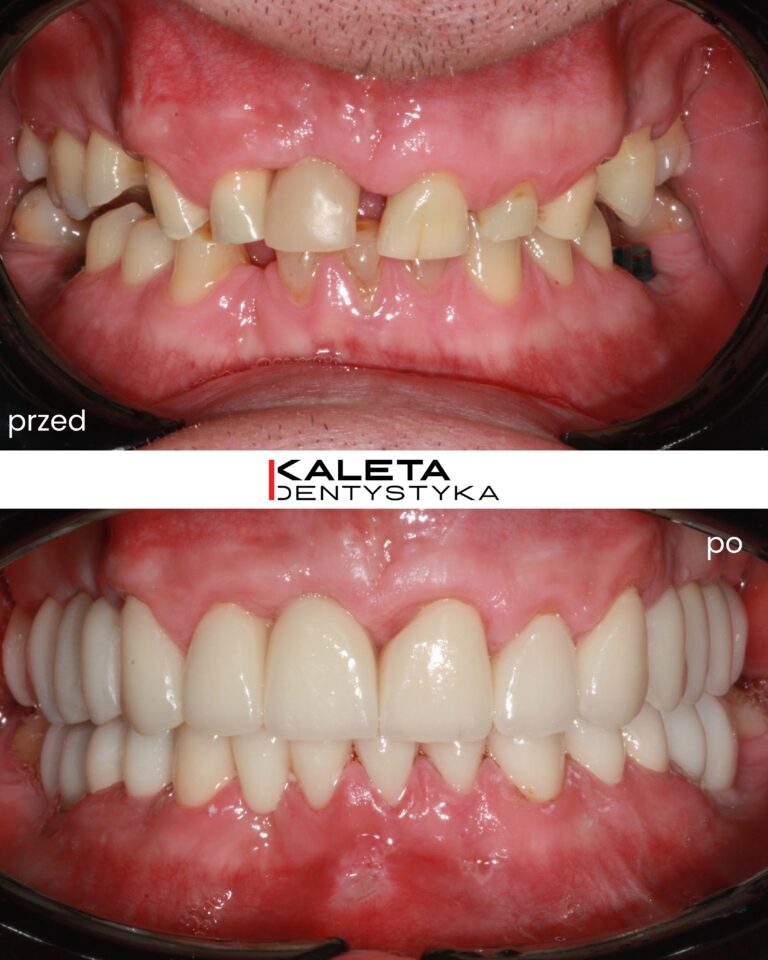 Leczenie implatoprotetyczne