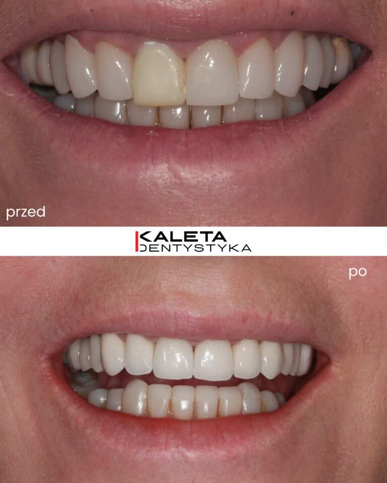 Korony i implantokorony