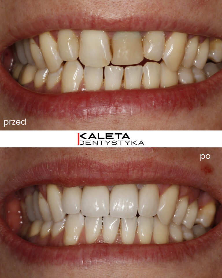 Korony na górne zęby