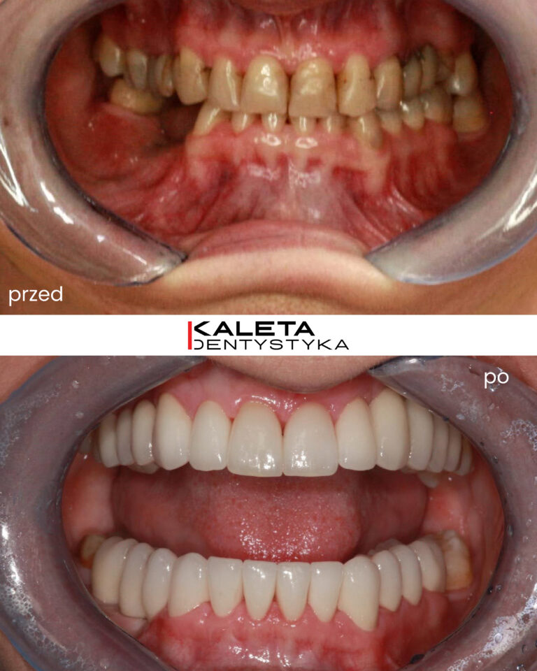 Implanty, korony i licówki